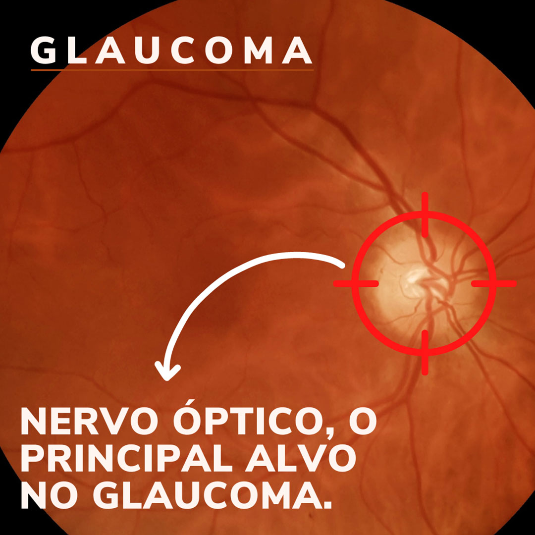 Entenda o que é o glaucoma: